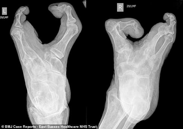 Cụ bà 94 nuôi con và đan len dù bàn tay chỉ có 3 ngón Cu ba 94 nuoi con va dan len du ban tay chi co 3 ngon