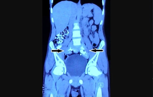 Chụp phim thấy 2 quả thận biến mất, chỉ còn 1… chiếc đĩa!