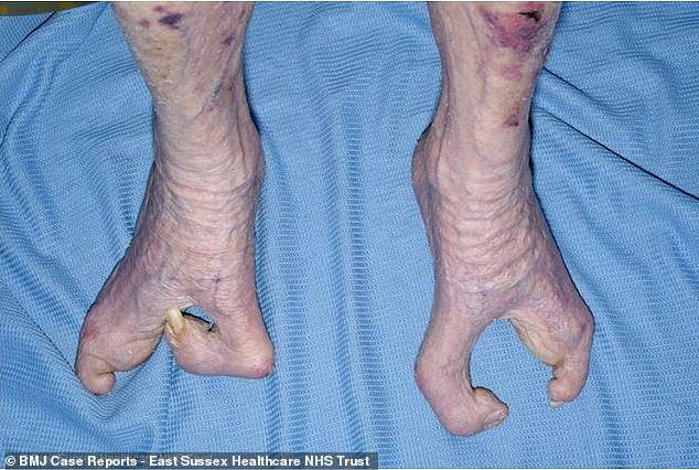 Cụ bà 94 nuôi con và đan len dù bàn tay chỉ có 3 ngón Cu ba 94 nuoi con va dan len du ban tay chi co 3 ngon