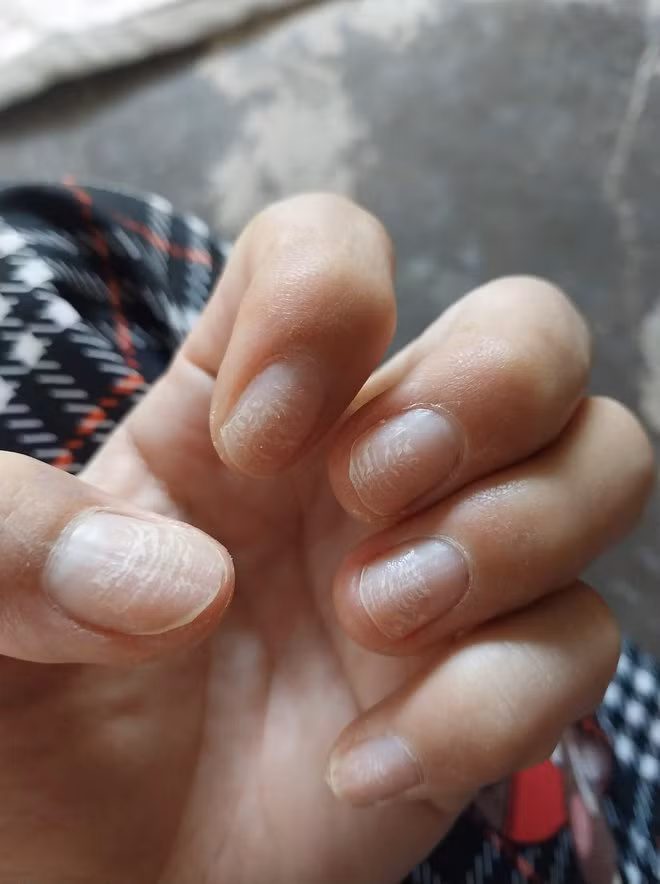 Nhiều bộ móng còn đứt gãy trầm trọng trông rất thiếu thẩm mỹ.