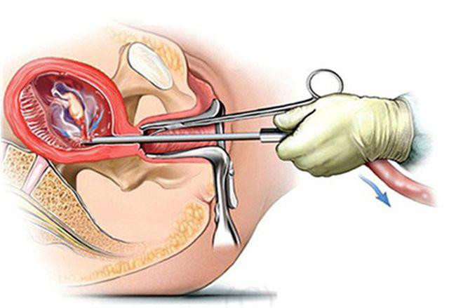 3 việc làm gây tổn thương cho tử cung, rất nhiều phụ nữ mắc phải ảnh 3 ba viec lam cua phu nu gay ton thuong cho tu cung, rat nhieu nguoi mac phai - 3