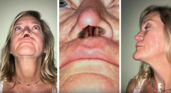 Xót xa người phụ nữ 11 năm sống với một lỗ mũi ảnh 2 Xót xa người phụ nữ 11 năm sống với một lỗ mũi