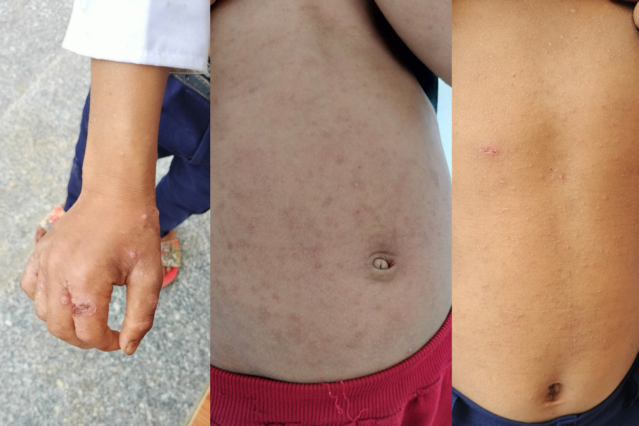 Dấu hiệu của bệnh ghẻ. Dấu hiệu của bệnh ghẻ.