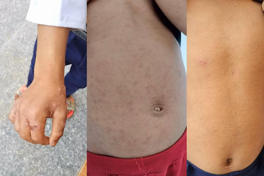 Dấu hiệu của bệnh ghẻ.