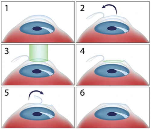 5 phương pháp chữa cận thị cho người không muốn đeo kính