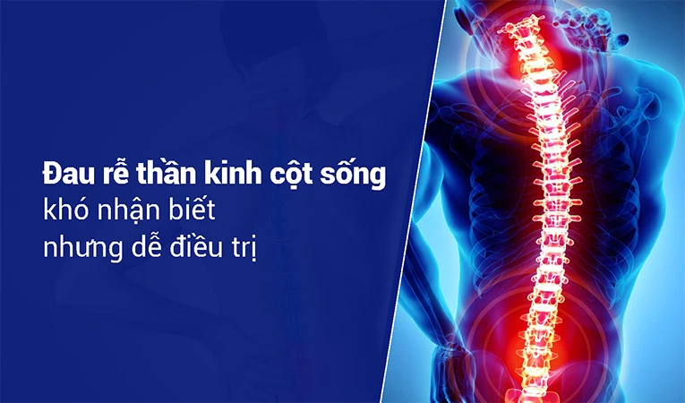 Đau rễ thần kinh cột sống ảnh hưởng lớn đến sinh hoạt và công việc