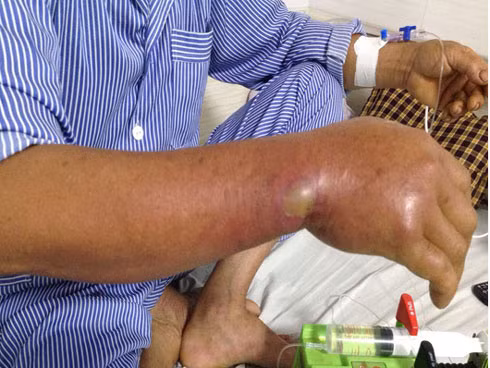 Cắt cỏ cá tại bờ ruộng, 5 ngày sau người đàn ông suýt mất mạng vì lý do không ngờ ảnh 1