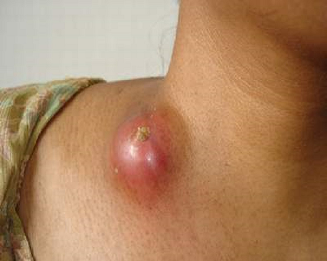 Vị trí mọc hạch nhỏ xíu nhưng là dấu hiệu bệnh ung thư cướp đi sinh mạng nhiều người ảnh 1 ung-thu-hach-2