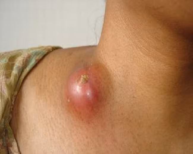 Vị trí mọc hạch nhỏ xíu nhưng là dấu hiệu bệnh ung thư cướp đi sinh mạng nhiều người ảnh 1 ung-thu-hach-2