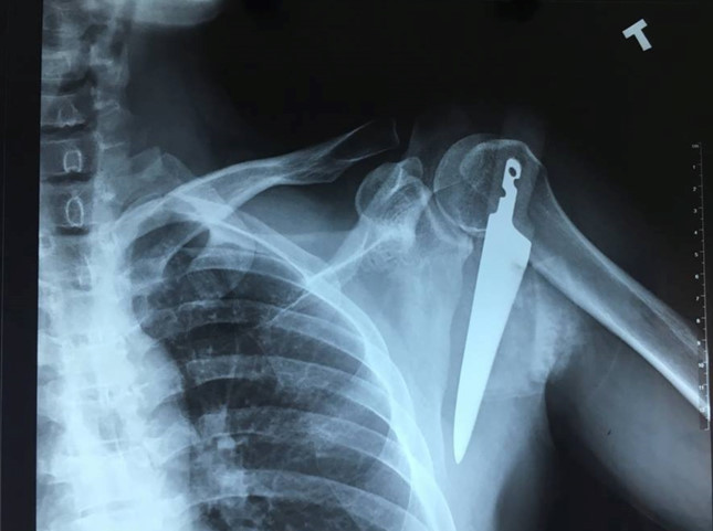 Vào bếp vấp ngã, người đàn ông bị dao đâm vào vai ảnh 1 Vào bếp vấp ngã, người đàn ông bị dao đâm vào vai ảnh 1