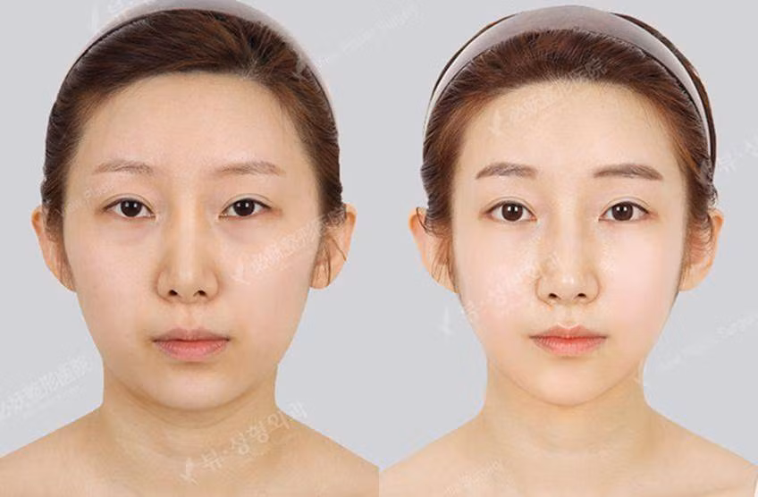 9 xu hướng phẫu thuật thẩm mỹ phổ biến nhất ở Hàn Quốc-3