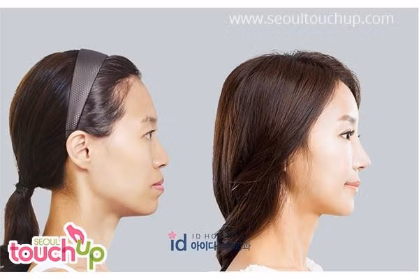 9 xu hướng phẫu thuật thẩm mỹ phổ biến nhất ở Hàn Quốc-5