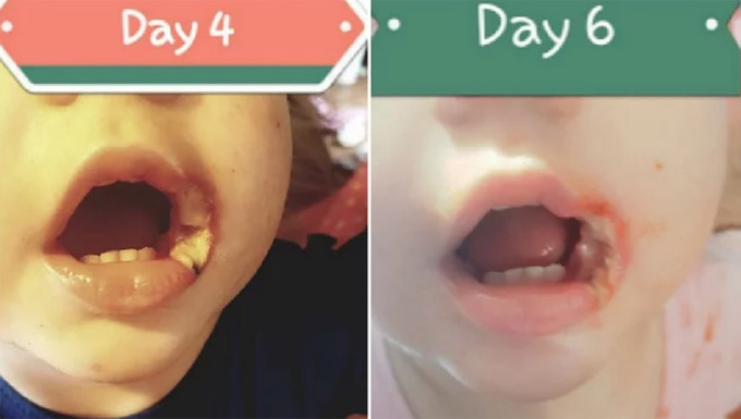 Bé bị bỏng miệng vì mẹ quên rút sạc điện thoại khỏi ổ điện ảnh 1 be-bi-bong-mieng-vi-me-quen-rut-sac-dien-thoai-khoi-o-dien