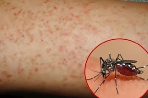 Các địa phương ghi nhận nhiều ca mắc tập trung ở các huyện Nhà Bè, Củ Chi và Cần Giờ