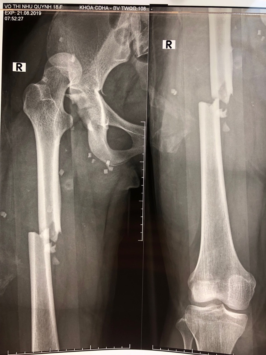 Hình ảnh phim chụp. Hình ảnh phim chụp.