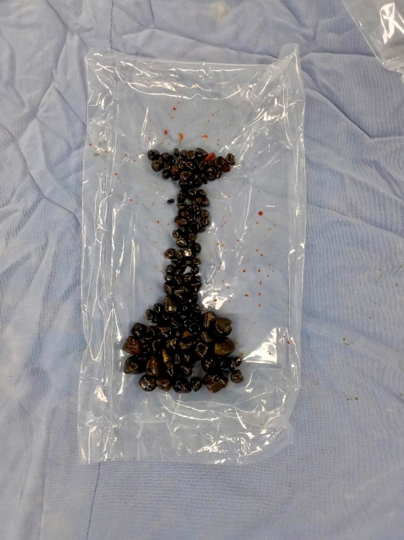 Hàng trăm viên sỏi được các bác sĩ phẫu thuật lấy ra từ túi mật của bệnh nhân H. (Ảnh: Phương Trinh) Hàng trăm viên sỏi được các bác sĩ phẫu thuật lấy ra từ túi mật của bệnh nhân H. (Ảnh: Phương Trinh)