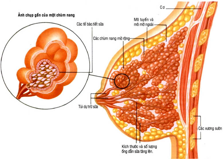 Điều trị u vú bằng kỹ thuật hút chân không (Ảnh minh họa).