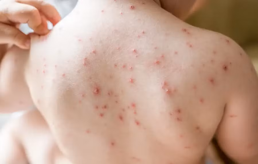 TPHCM ghi nhận 2 trẻ mắc bệnh sởi chưa tiêm vắc-xin 