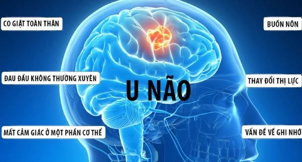 Cảnh giác với bệnh u não. Ảnh minh họa. 