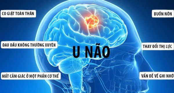 Cảnh giác với bệnh u não. Ảnh minh họa. 