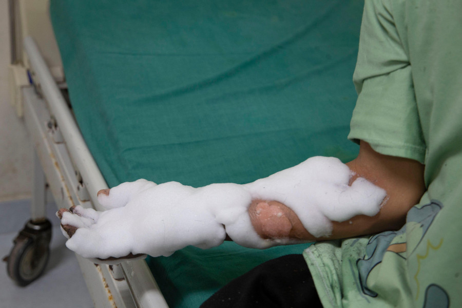 Bàn tay bị bỏng do điện thoại phát nổ trong lúc vừa cắm sạc vừa sử dụng. Ảnh: Bệnh viện Đa khoa Trung ương Quảng Nam.