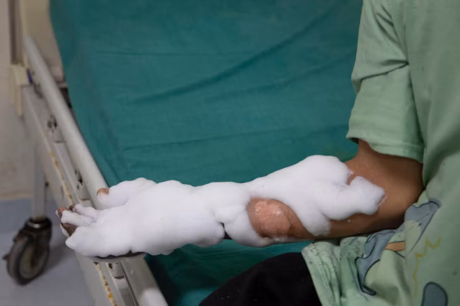 Bàn tay bị bỏng do điện thoại phát nổ trong lúc vừa cắm sạc vừa sử dụng. Ảnh: Bệnh viện Đa khoa Trung ương Quảng Nam.