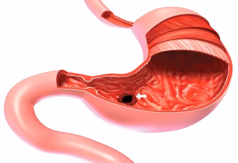 Cứu bé gái 8 tuổi bị thủng dạ dày