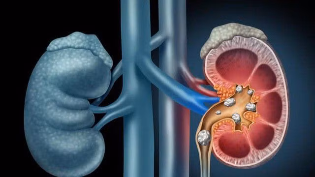Bệnh sỏi thận ảnh hưởng lớn tới chất lượng sống.