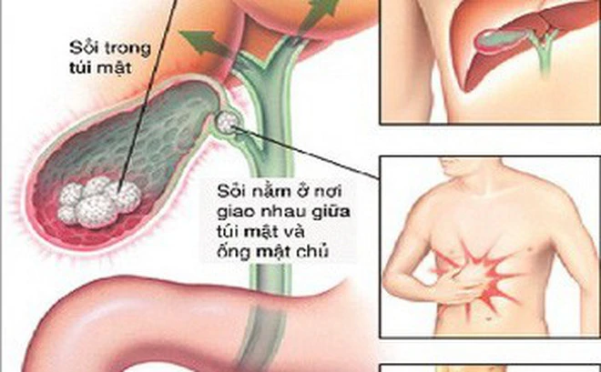 Bệnh lý sỏi mật cần được phát hiện và điệu trị sớm 