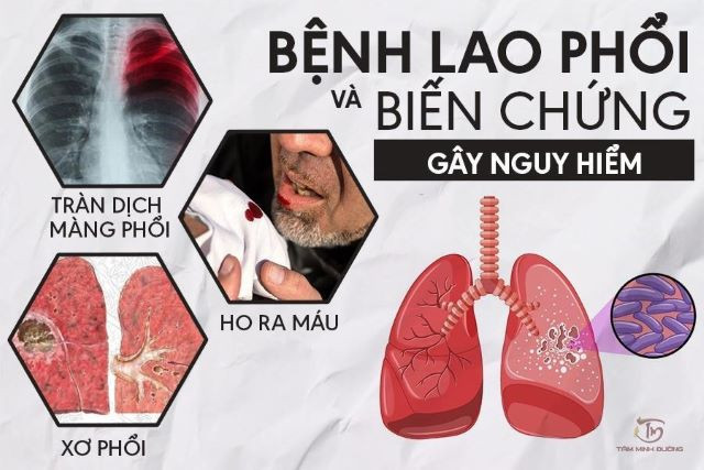 Kỹ thuật mới giúp bệnh nhân Lao kháng đa thuốc quản lí biến cố bất lợi 