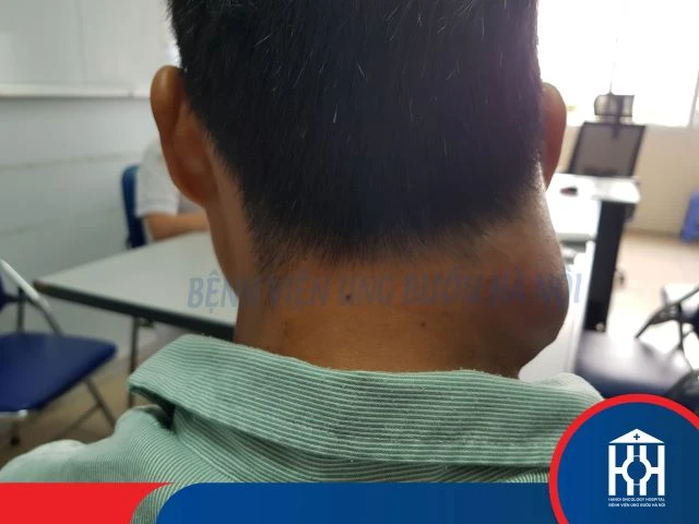 Phát hiện u ở cổ, đắp thuốc nam khiến khối u di căn.