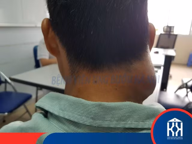 Phát hiện u ở cổ, đắp thuốc nam khiến khối u di căn.