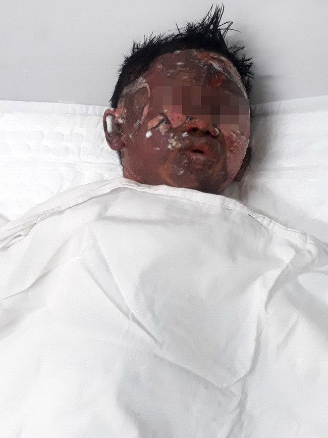 Nạn nhân N.T.V đã qua được giai đoạn đầu của sốc bỏng, không sốt (Ảnh: BVCC) Nạn nhân N.T.V đã qua được giai đoạn đầu của sốc bỏng, không sốt (Ảnh: BVCC)