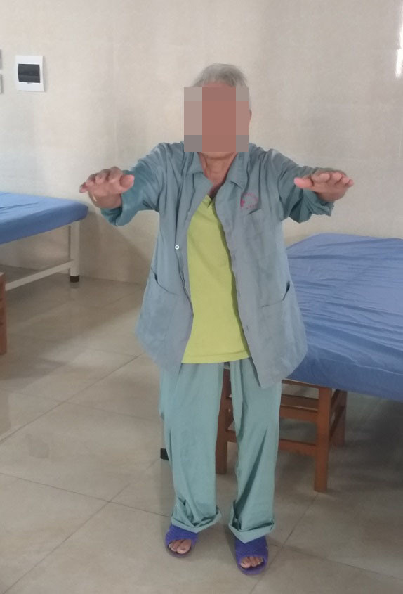 Bệnh nhân đã có thể vận động (BVCC). Bệnh nhân đã có thể vận động (BVCC).