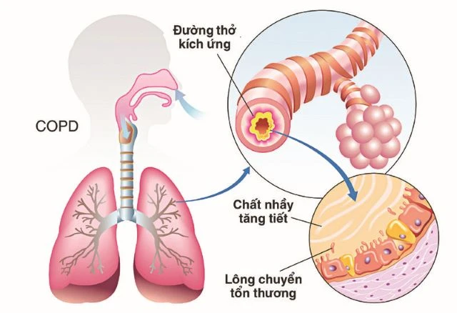 Bệnh phổi tắc nghẽn mạn tính: ảnh hưởng tới chất lượng cuộc sống.