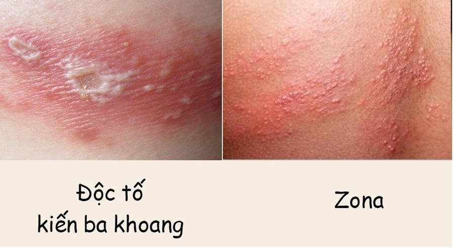 Nọc kiến ba khoang cực độc (Ảnh Minh họa). Nọc kiến ba khoang cực độc (Ảnh Minh họa).