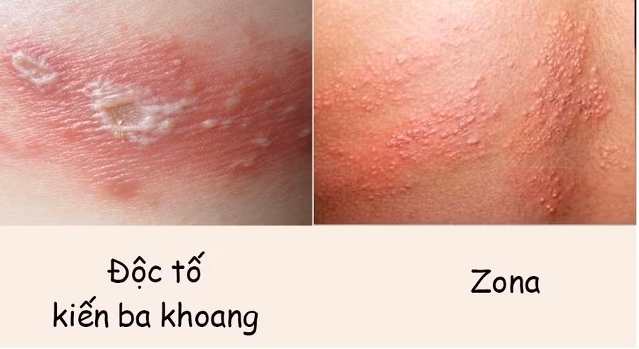 Nọc kiến ba khoang cực độc (Ảnh Minh họa).