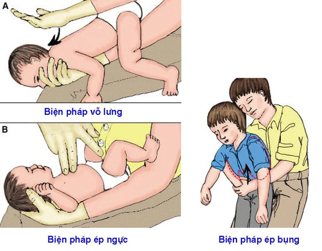 Các biện pháp sơ cứu khi hóc dị vật (MH)