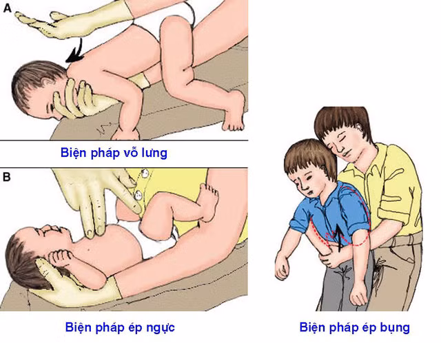 Các biện pháp sơ cứu khi hóc dị vật (MH)