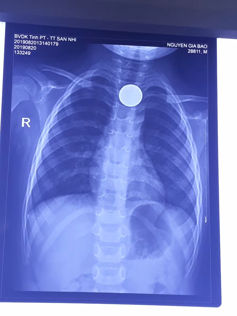 Phim chụp hình ảnh dị vật (BVCC)