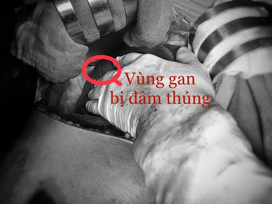 Phần gan bị đâm thủng