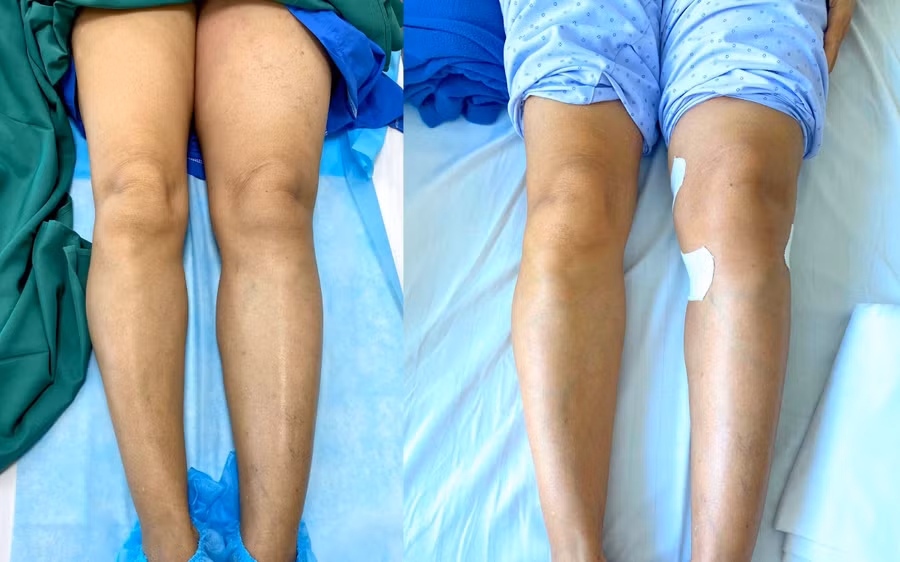 Đùi và chân trái bệnh nhân sưng phù, căng bóng (hình trái) và sau khi can thiệp khơi thông đoạn tĩnh mạch tắc nghẽn (hình phải). Ảnh: BVCC