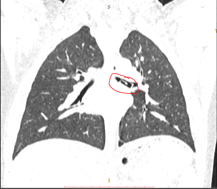 Dị vật nằm trong phế quản cháu bé.