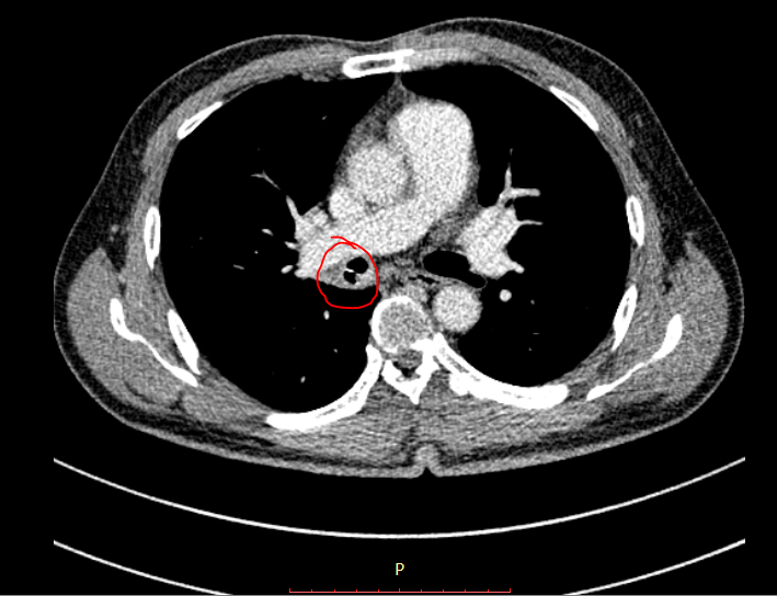 Xương cá nằm trong phế quản.