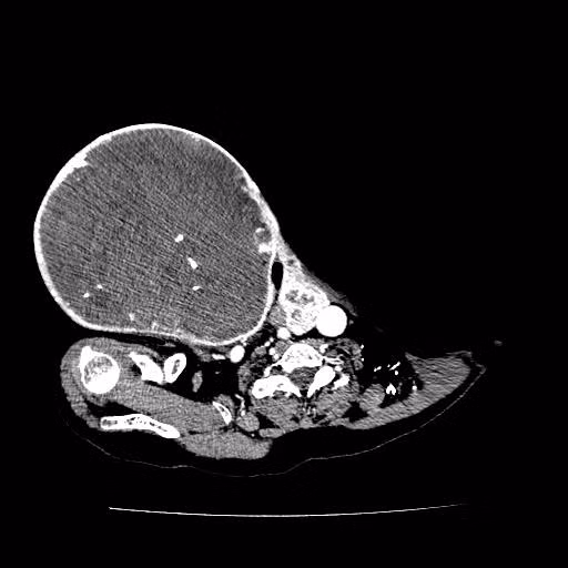 Phim chụp khối u (BVCC). Phim chụp khối u (BVCC).