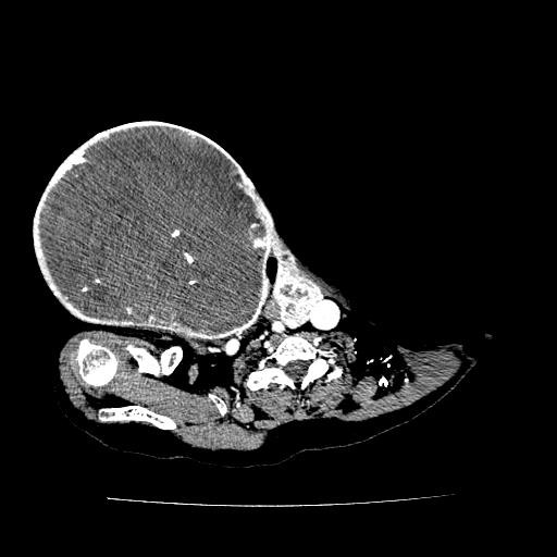 Phim chụp khối u (BVCC). Phim chụp khối u (BVCC).