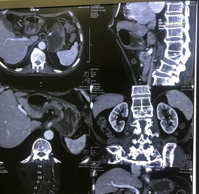 Phim chụp khối U bệnh nhân T (Ảnh BVCC).