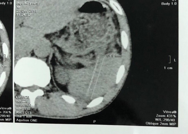 Hình chụp CT scaner thấy cây tăm trong ổ bụng bệnh nhân. Ảnh BVCC Hình chụp CT scaner thấy cây tăm trong ổ bụng bệnh nhân. Ảnh BVCC