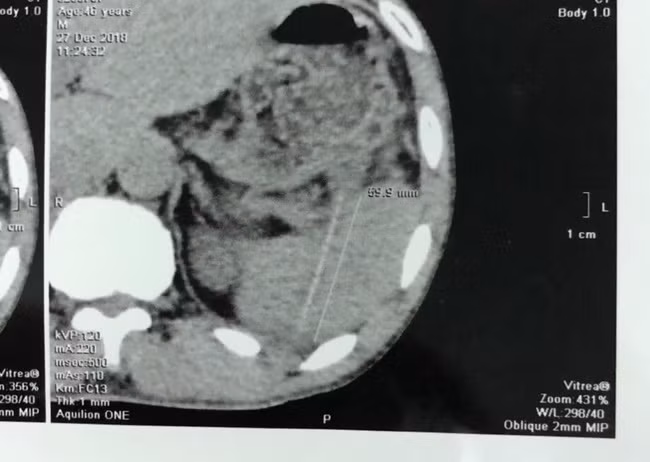 Hình chụp CT scaner thấy cây tăm trong ổ bụng bệnh nhân. Ảnh BVCC