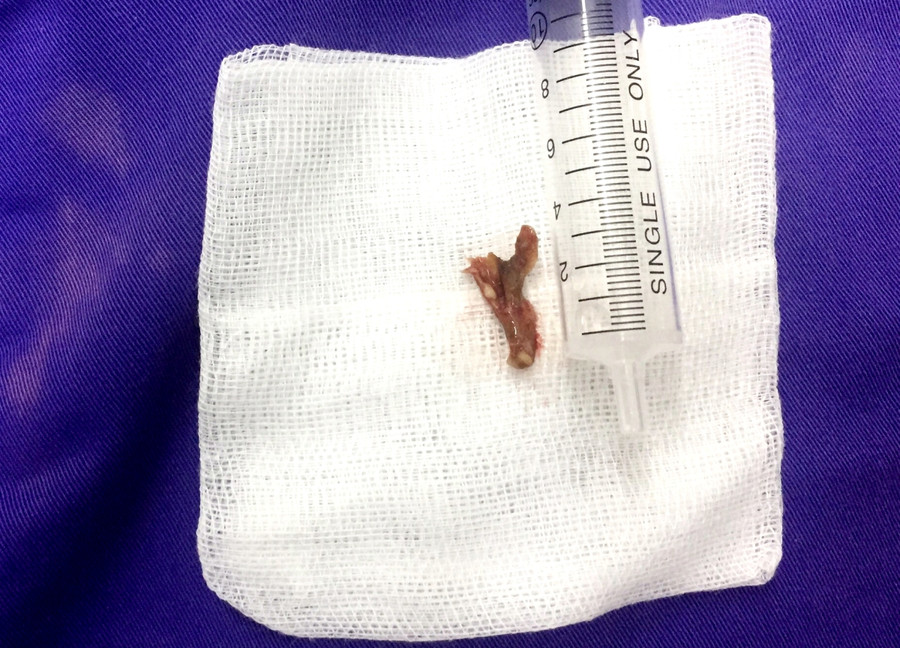 Xương cá được gắp ra. Xương cá được gắp ra.